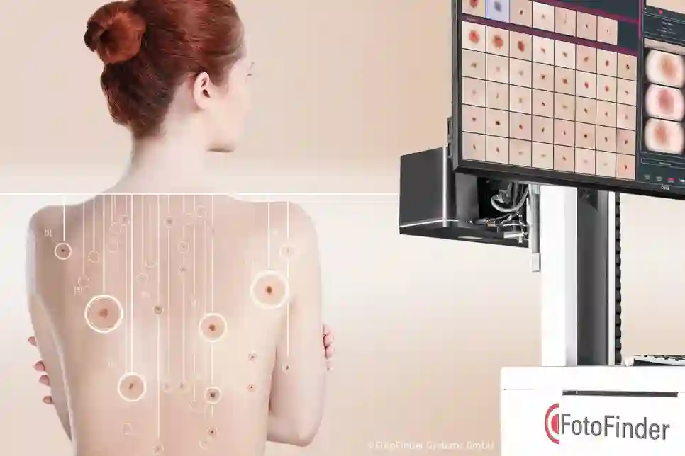 FotoFinder predstavio novi sustav za rano otkrivanje raka kože